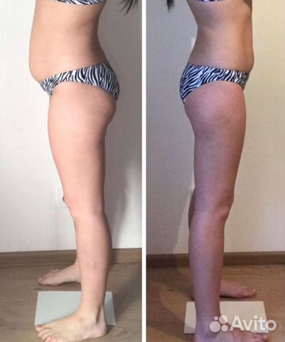 Антицеллюлитный массаж