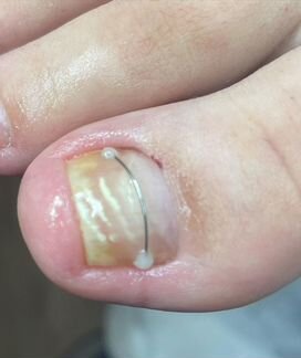 Педикюр лечебный - подолог